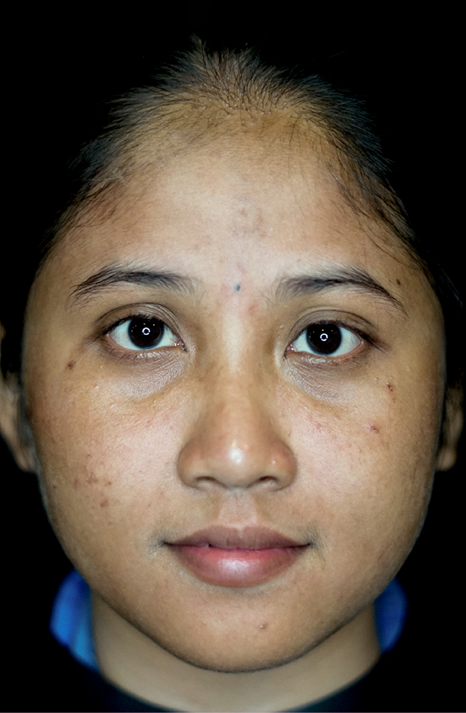 Photo Laser Blackdoll Before